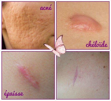 naturo cicatrice difficile