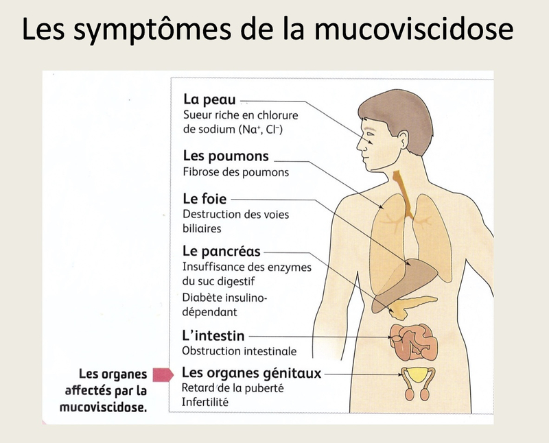 photo symptomes de la mucoviscidose