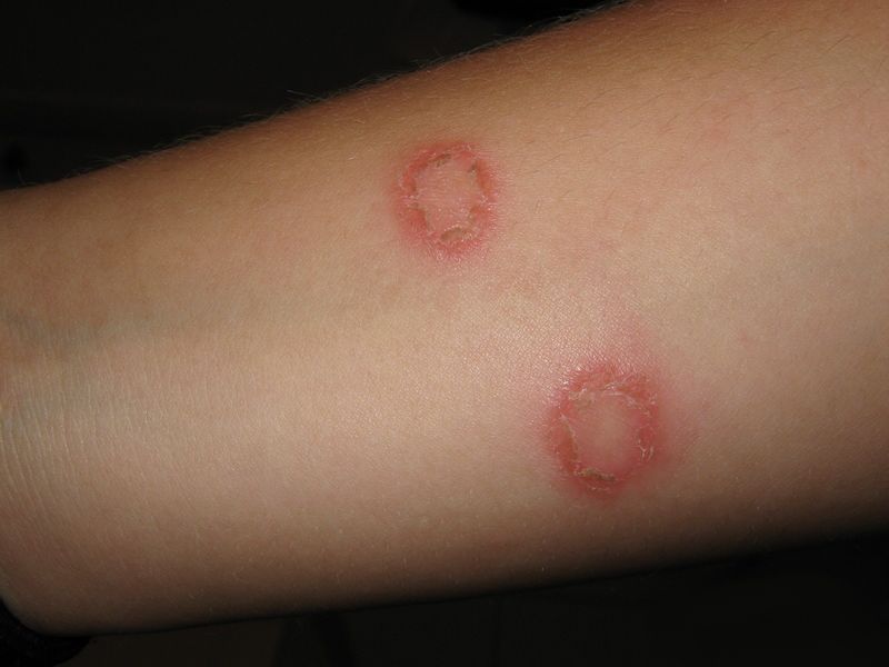 herpes au pied herpes au pied