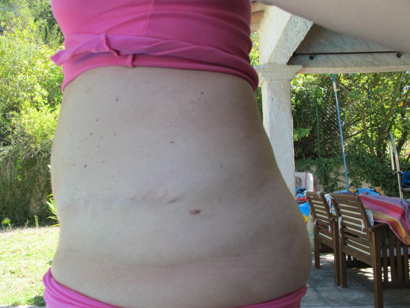 6 mois post op de côté - Photo de Abdominoplastie - Cali 6 mois post op de côté - Photo de Abdominoplastie - Cali